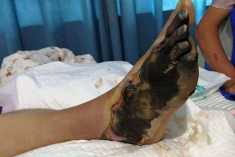 气性坏疽脚背皮肤发黑图 气性坏疽脚背皮肤发黑图