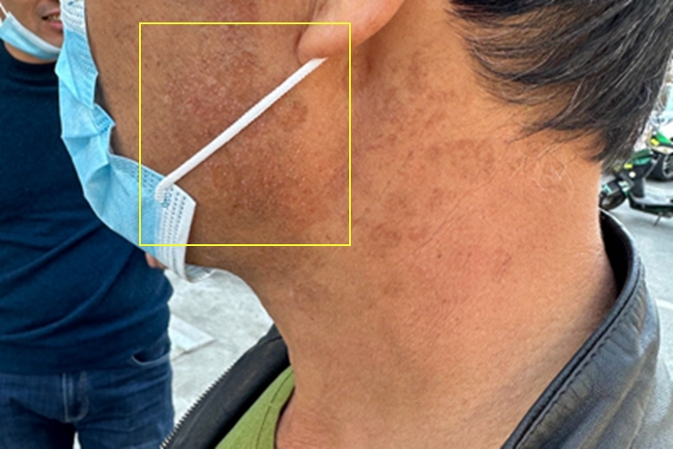 脂溢性角化病面部皮肤粗糙图