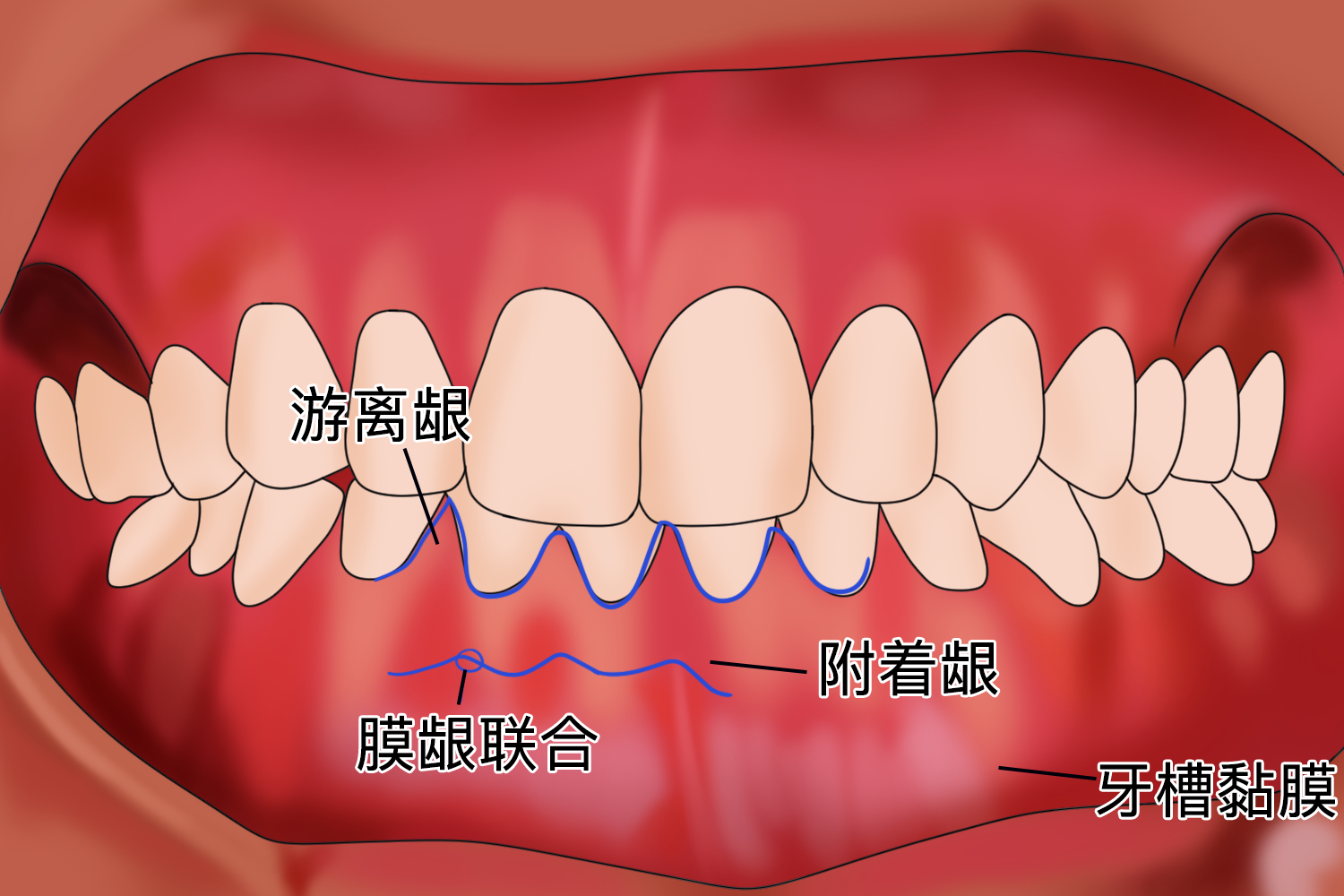牙槽黏膜位置图
