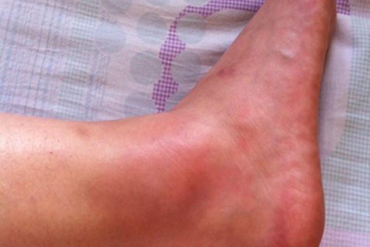 踝扭伤脚踝发红伴肿胀图