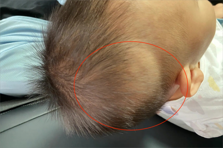 头皮血肿肿块图