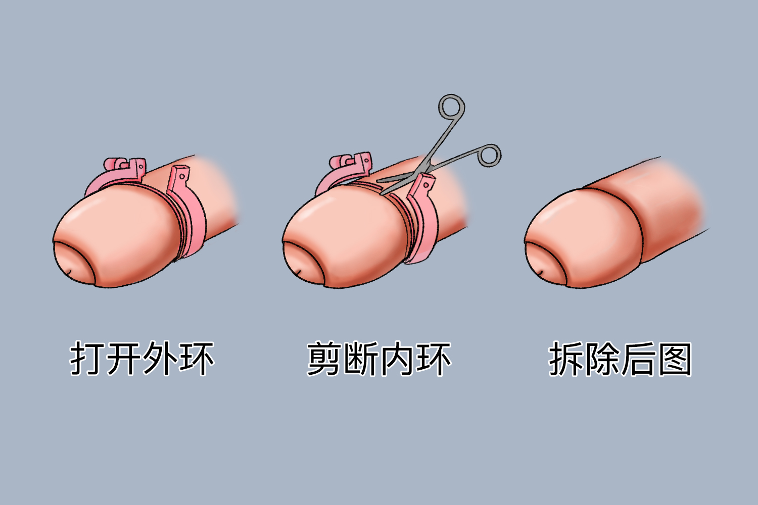 商环手术拆环过程图