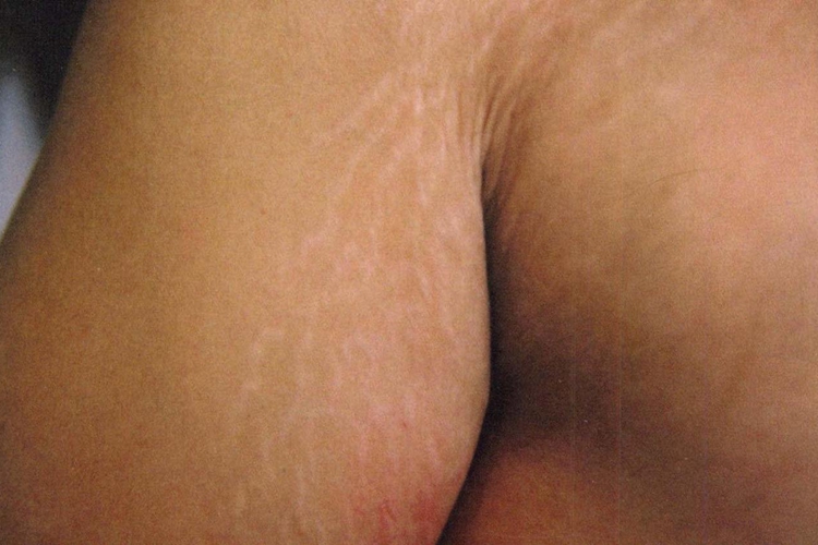 皮肤萎缩纹图 皮肤萎缩纹图