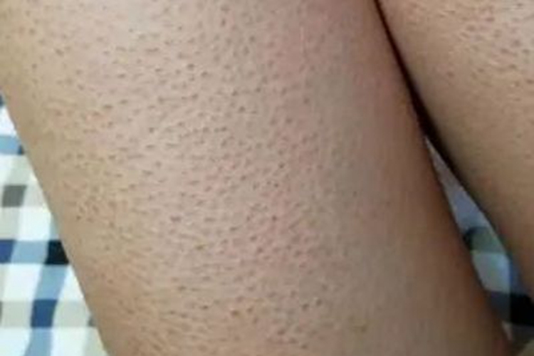 鳞状毛囊角化病大腿黑点图 鳞状毛囊角化病大腿黑点图