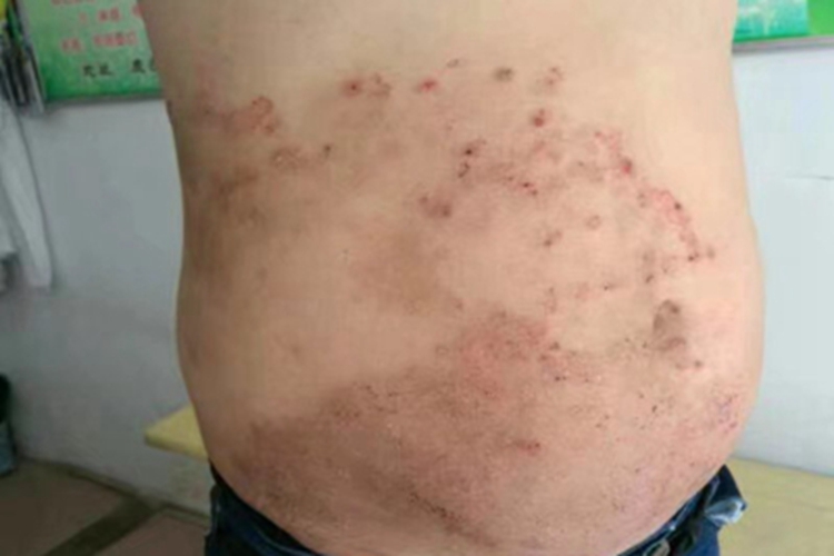 体癣右腹症状图 体癣右腹症状图