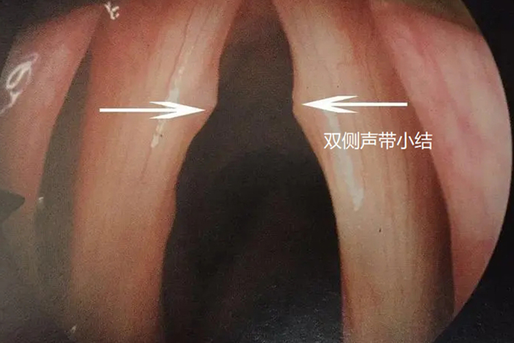 双侧声带小结图