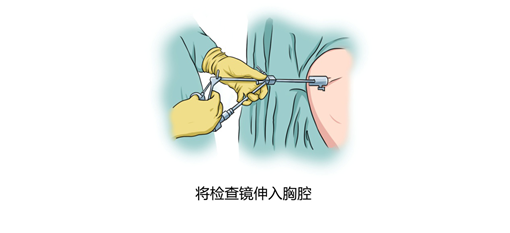 胸腔镜检查步骤