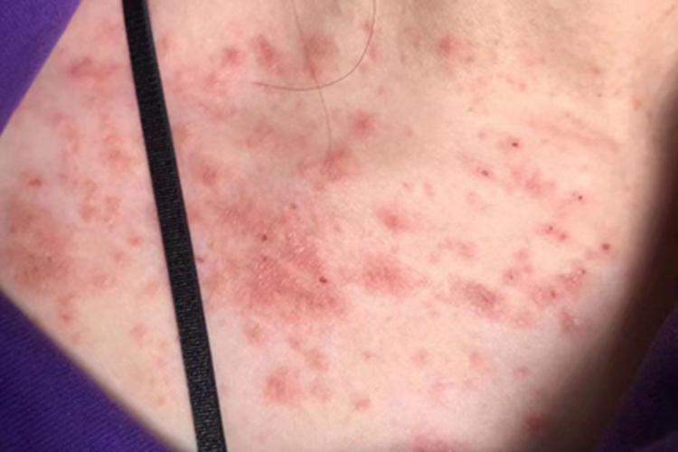 过敏性皮炎胸部红斑图 过敏性皮炎胸部红斑图