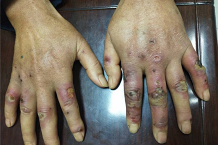 冻疮手部紫红糜烂图