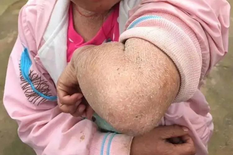 鱼鳞病图 鱼鳞病图