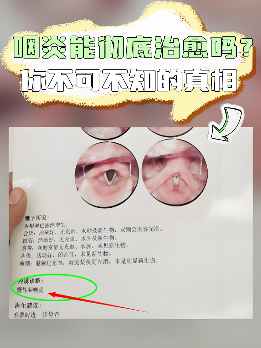咽炎能彻底治愈吗？你不可不知的真相