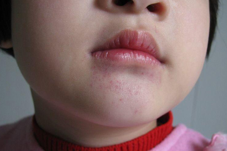 儿童嘴巴周围紫血点图 儿童嘴巴周围紫血点图