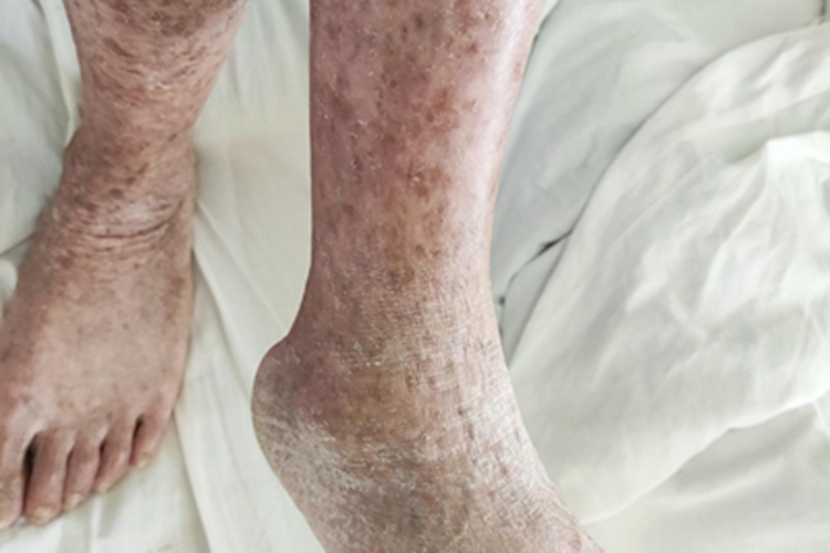 慢性湿疹小腿长斑干燥脱屑图