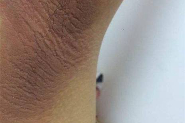 假性黑棘皮病图