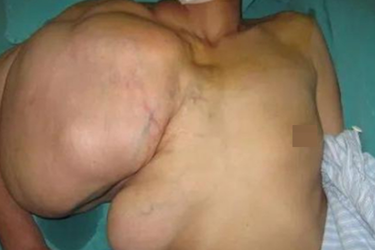 脂肪肉瘤胸上有肿块图