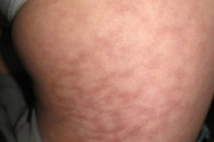 火激红斑大腿皮肤颜色加深图 火激红斑大腿皮肤颜色加深图