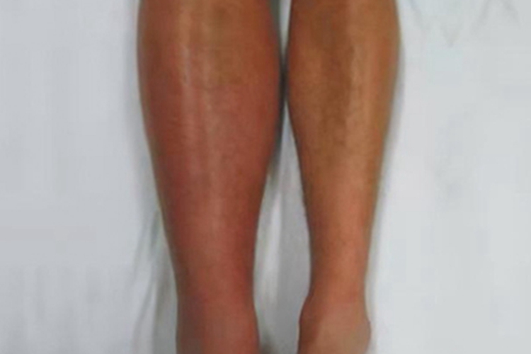 下肢深静脉血栓形成小腿肿胀图