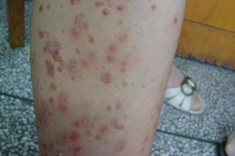 内脏利什曼病小腿症状图