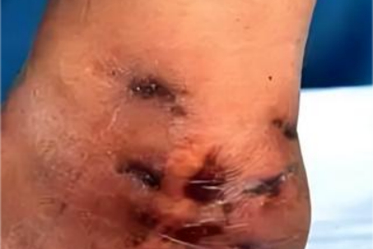 足菌肿脚跟很多结痂图