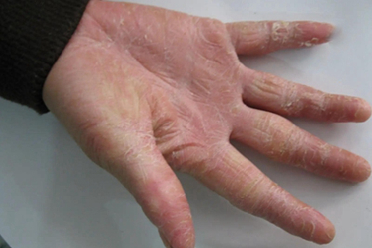 进行性指掌角皮症手掌脱皮图