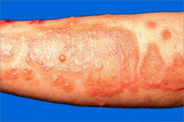 增殖型天疱疮小水疱图