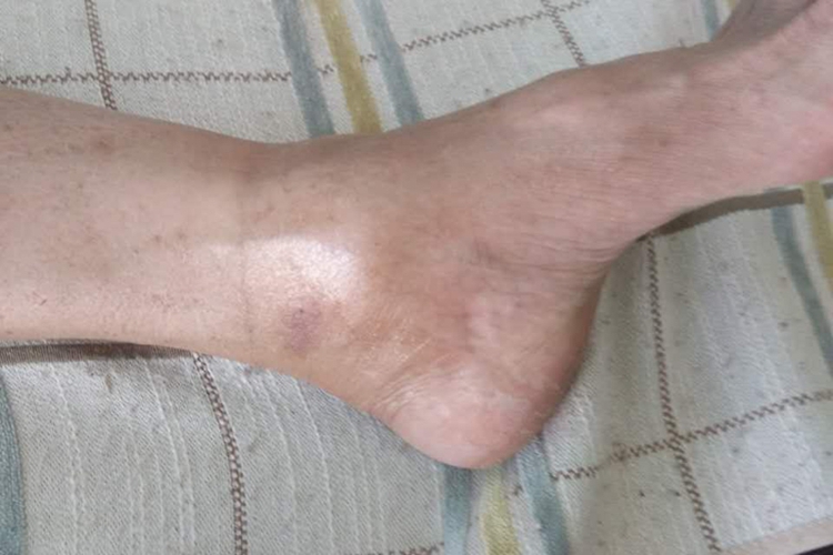 脚踝滑膜炎脚踝内侧肿胀图