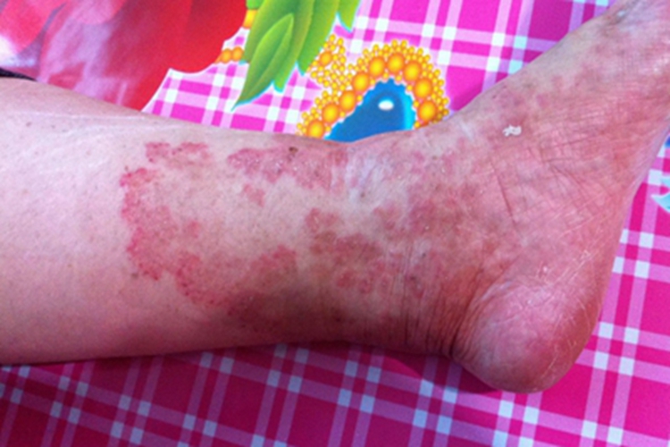 糖尿病性皮肤病脚踝症状图