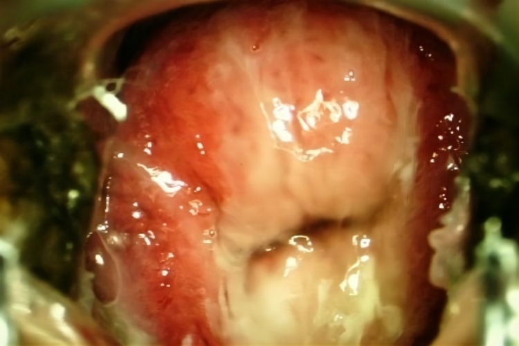 纳氏囊肿图 纳氏囊肿图