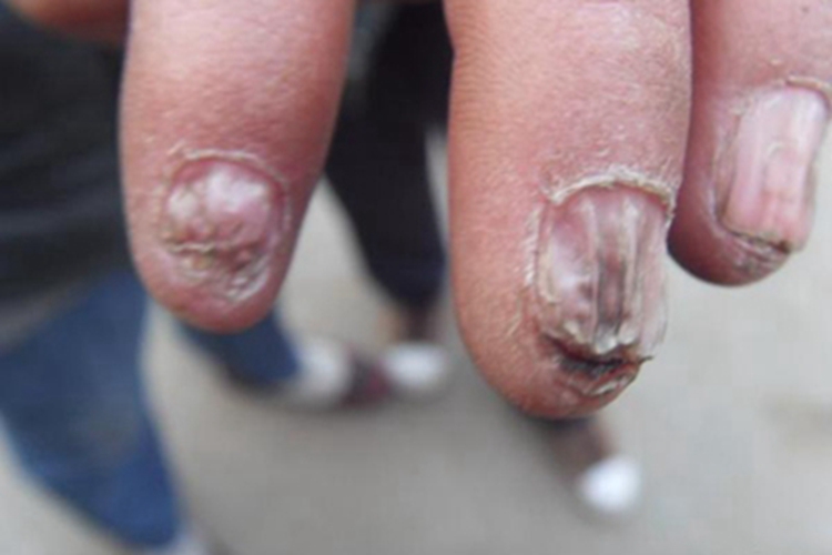 肠病性肢端皮炎手指甲萎缩变形图