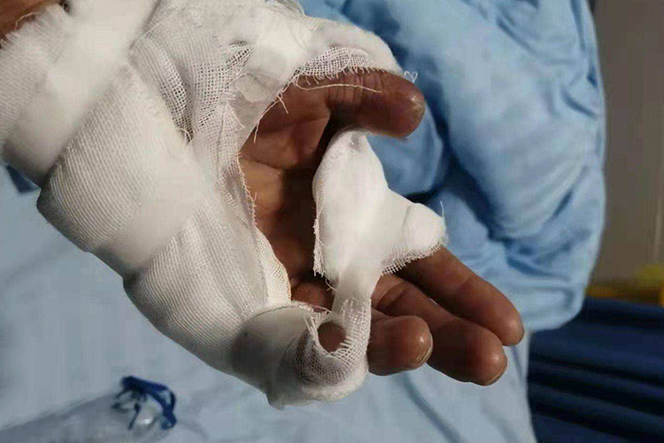 小拇指骨折掌侧成角打石膏图 小拇指骨折掌侧成角打石膏图