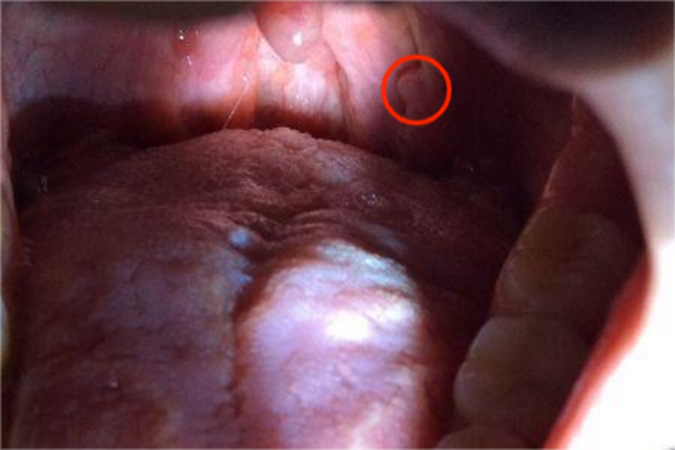 咽部乳头状瘤图