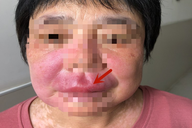 局限性口面部肉芽肿病结节图