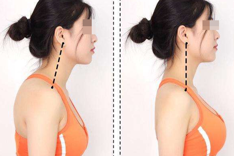 脖子前倾与正常状态对比图