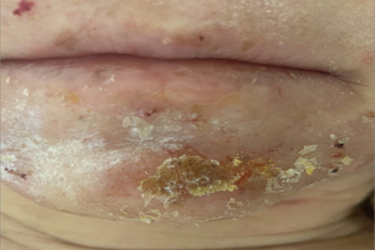 湿疹型药疹下巴结黄痂图
