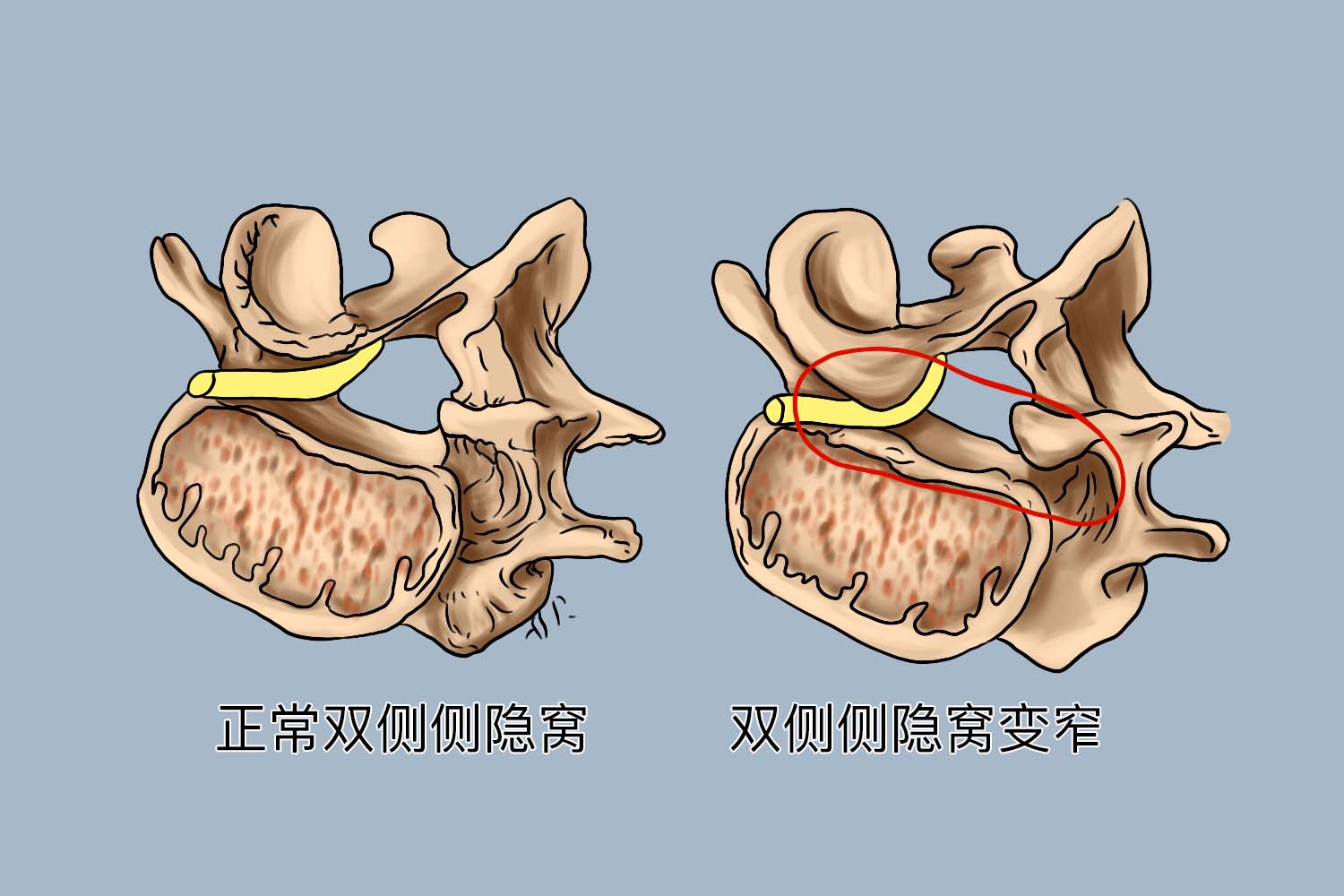 双侧侧隐窝变窄图 双侧侧隐窝变窄图