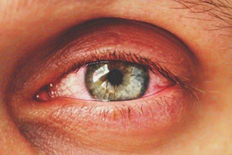 干眼症眼部症状图 干眼症眼部症状图