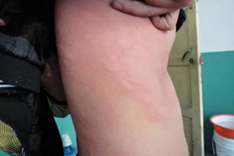 日光性荨麻疹背部疙瘩图