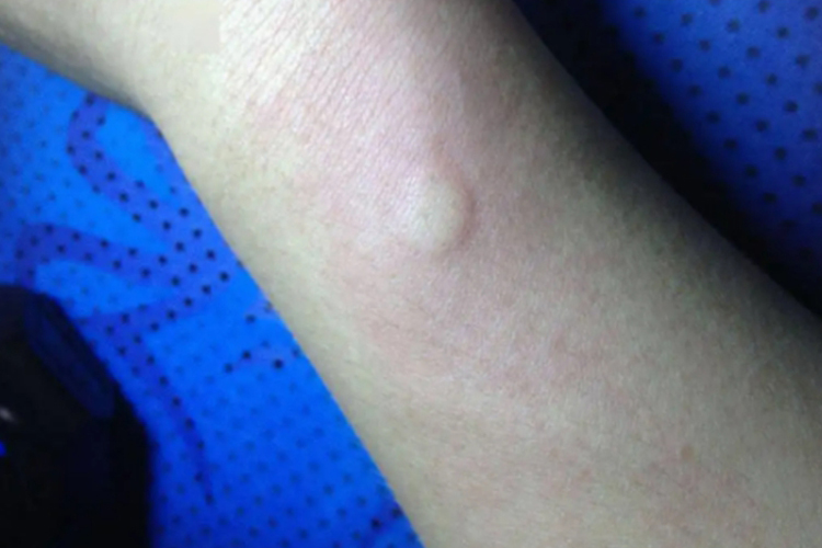 青霉素皮试过敏图