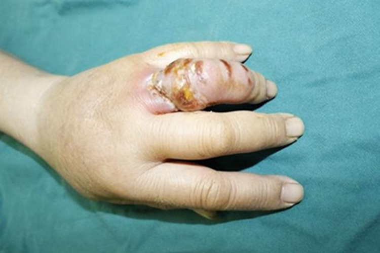 皮肤非典型分枝杆菌病手指脓肿图