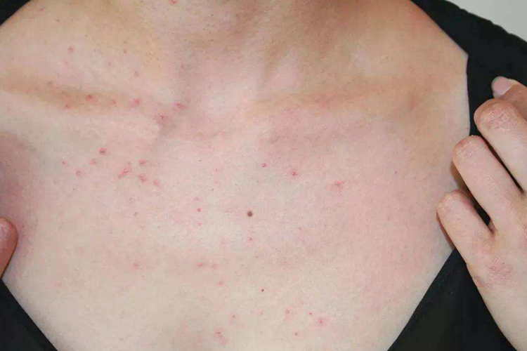 女生胸前毛囊炎图