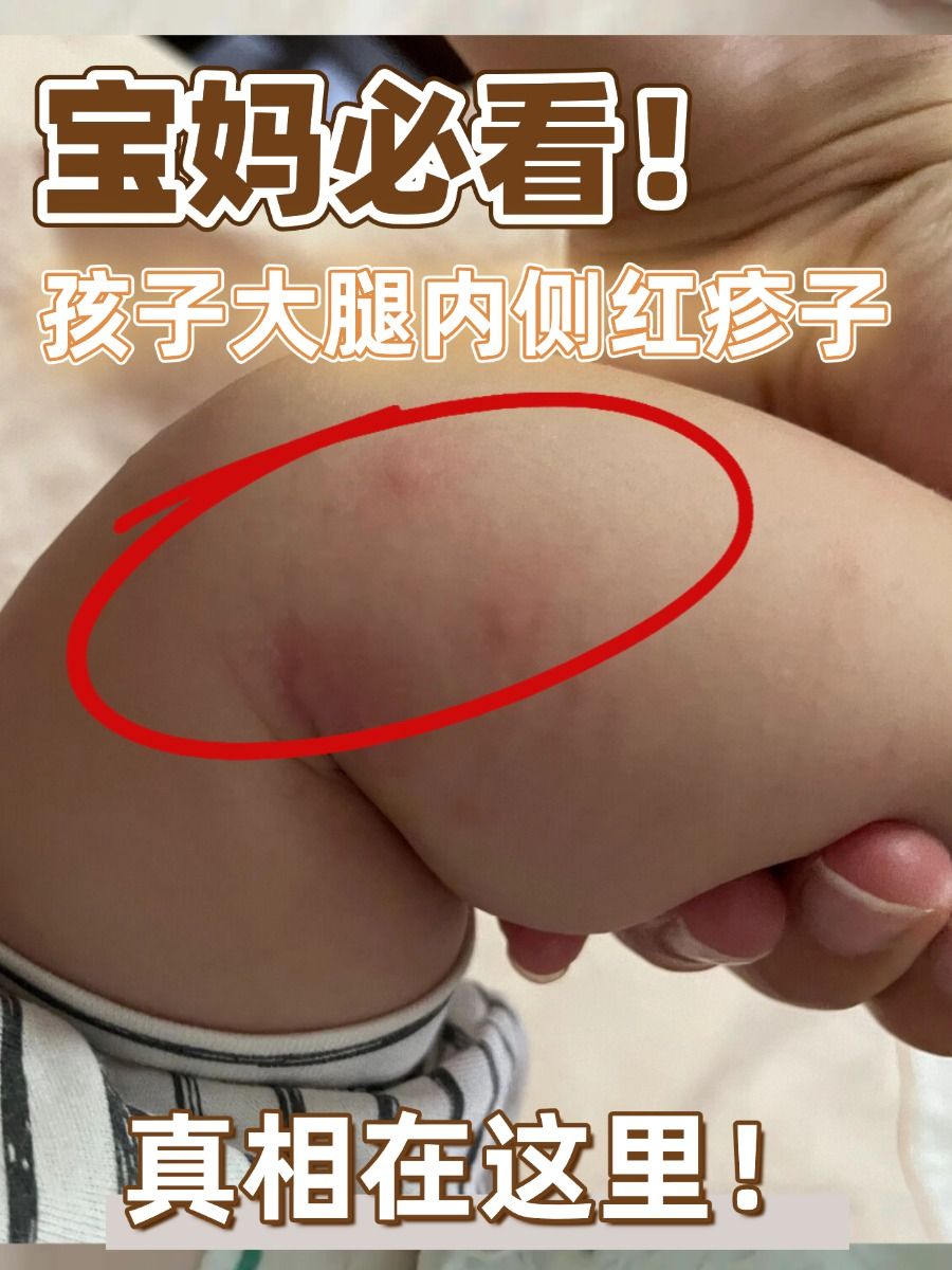 宝妈必看！孩子大腿内侧红疹子，真相在这里！