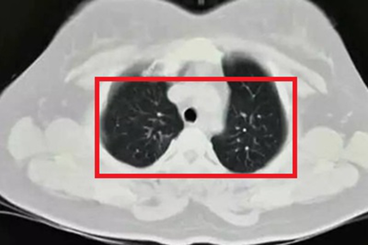 肺型组织胞浆菌病症状图 肺型组织胞浆菌病症状图