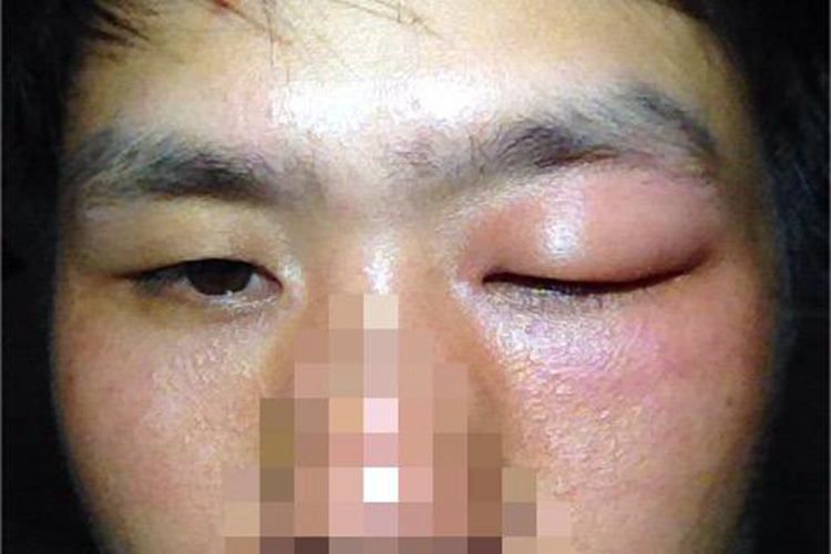 蜂蜇伤眼部症状图 蜂蜇伤眼部症状图
