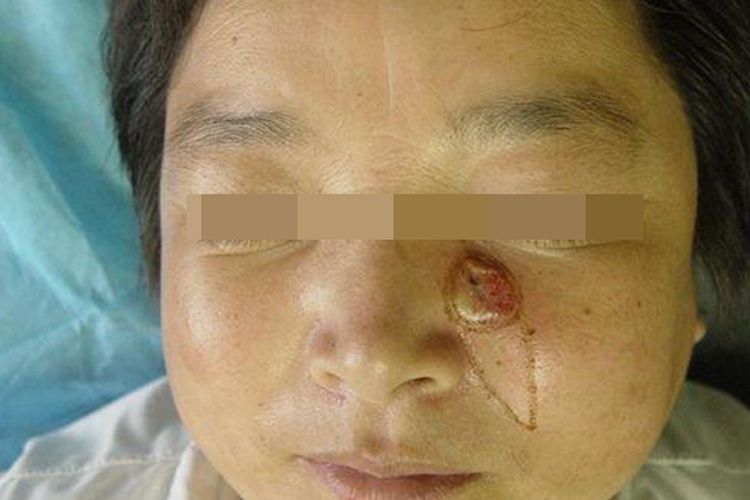 结节溃疡型基底细胞癌图