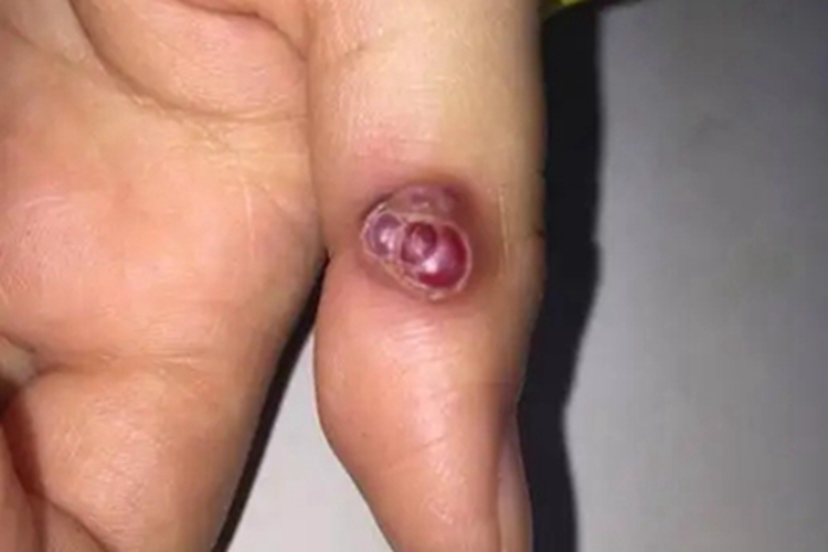 毛发肉芽肿手指疙瘩图