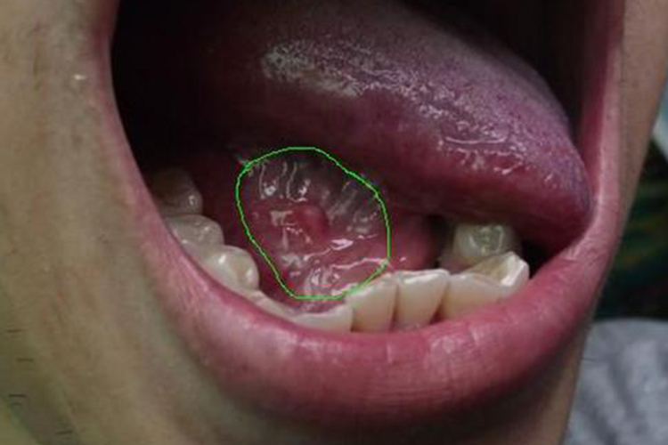 下颌下腺炎导管发炎图 下颌下腺炎导管发炎图