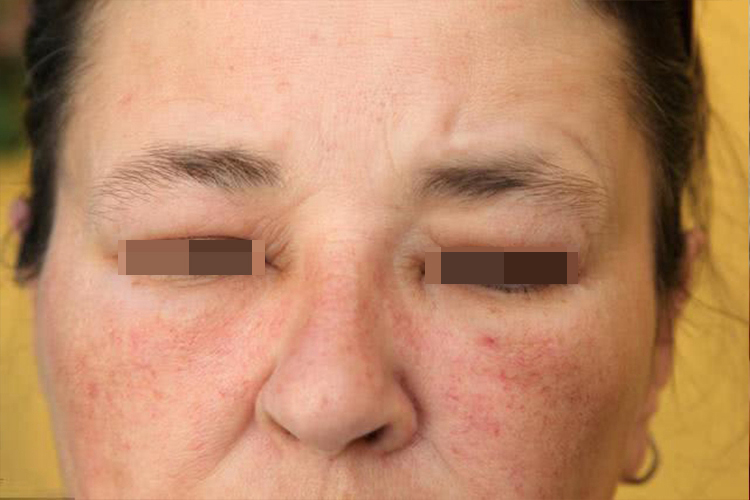 面部水肿抬头纹消失图 面部水肿抬头纹消失图