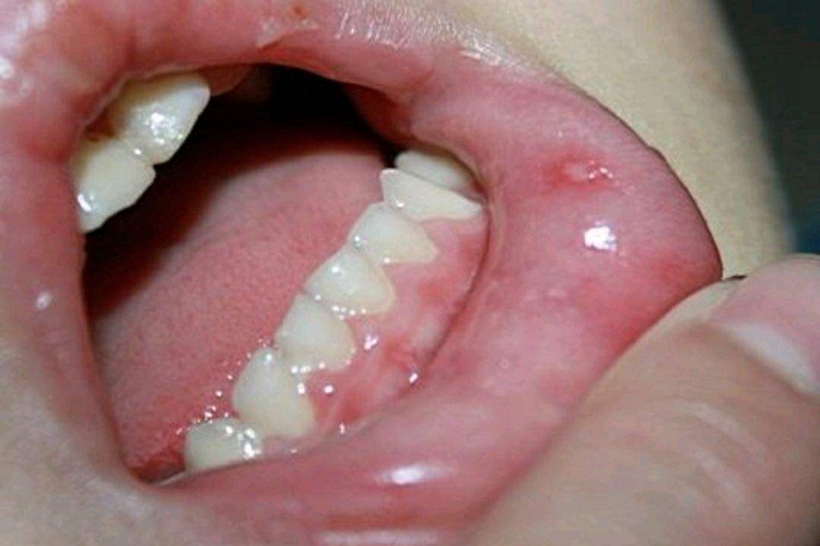 手足口病口腔图 手足口病口腔图