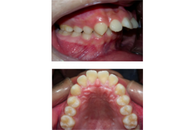 上颌前牙唇倾图