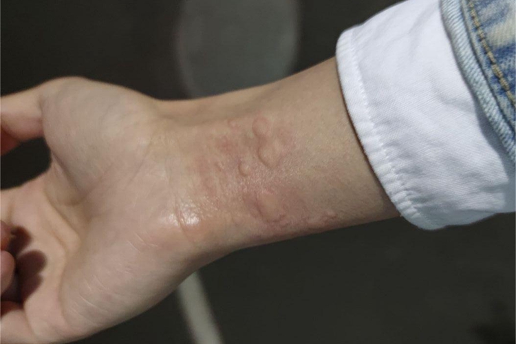 革螨皮炎手腕风团图